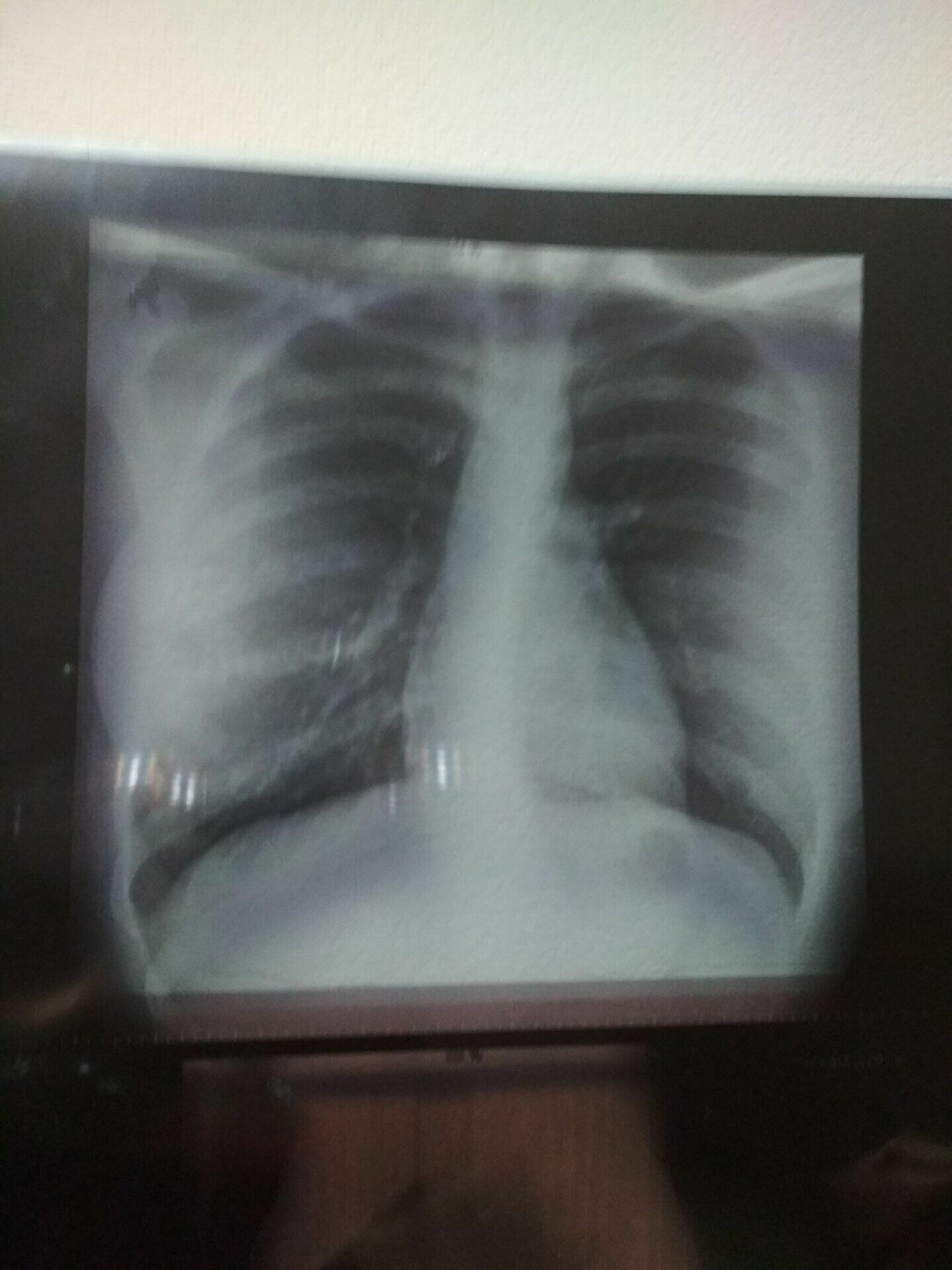 Рентгеновский снимок спины Александры Лисицыной
