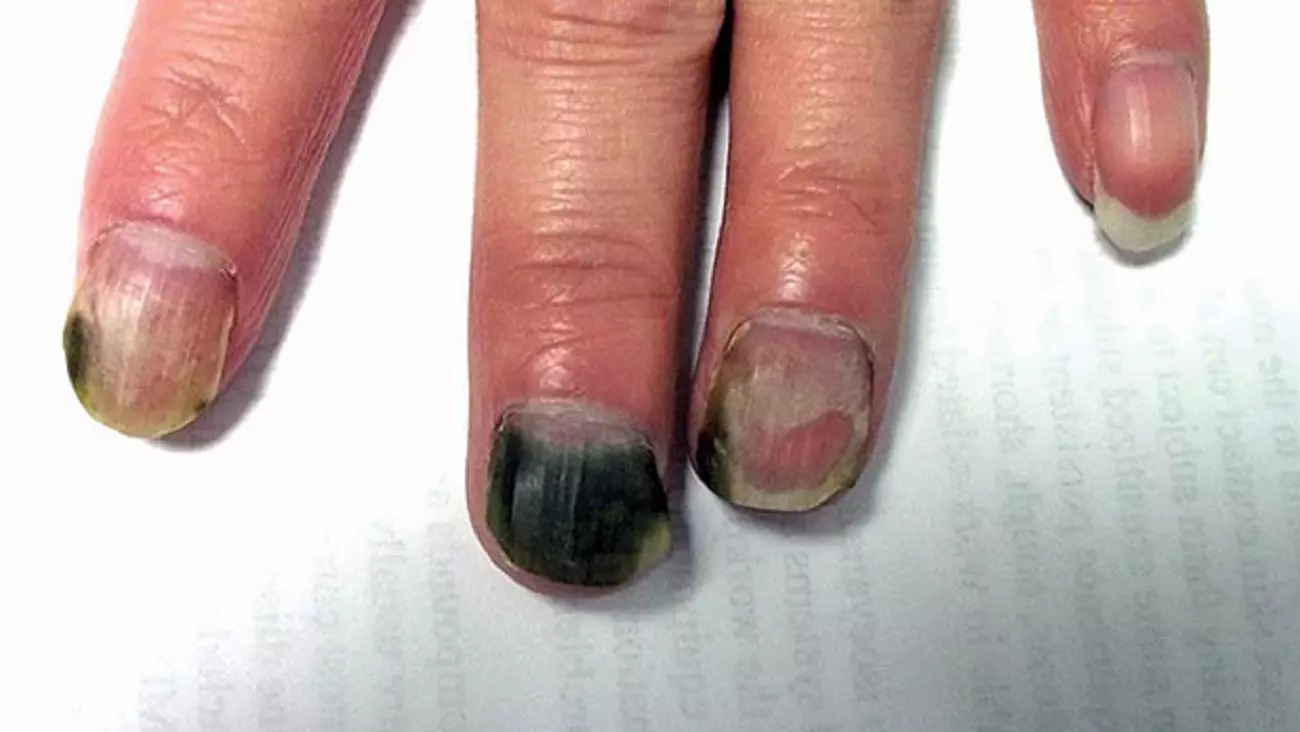 Синдром зеленого ногтя