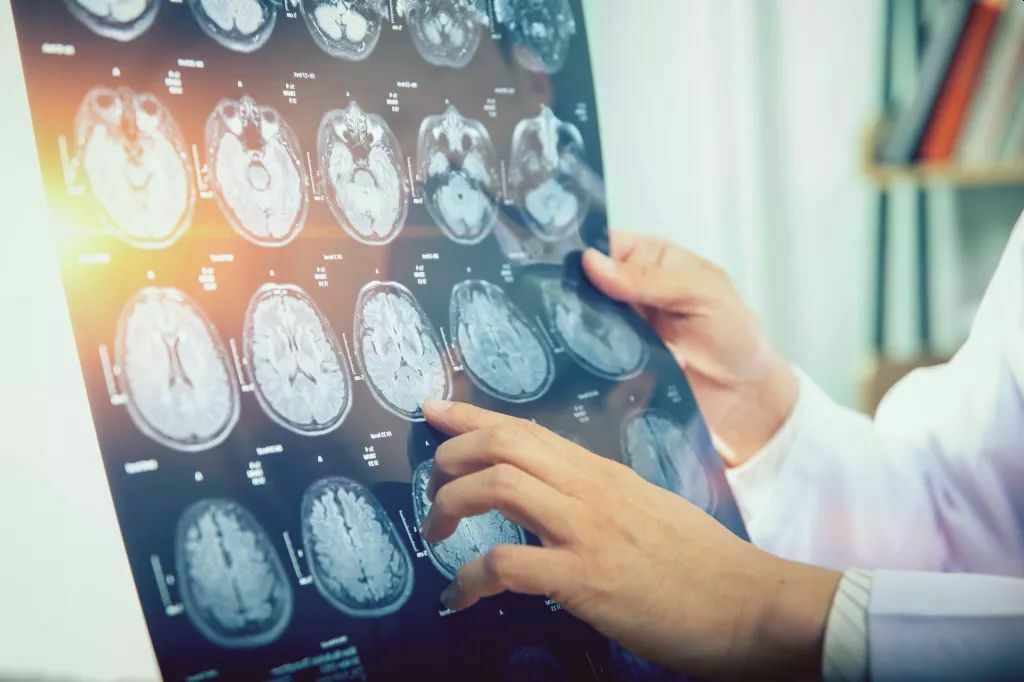 В Канаде обнаружили загадочную болезнь мозга