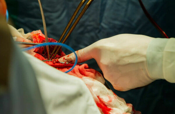 Трепанация бытовой дрелью: красноярские врачи оперируют без мединструментов