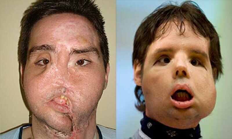 Первая полная пересадка лица: до и после