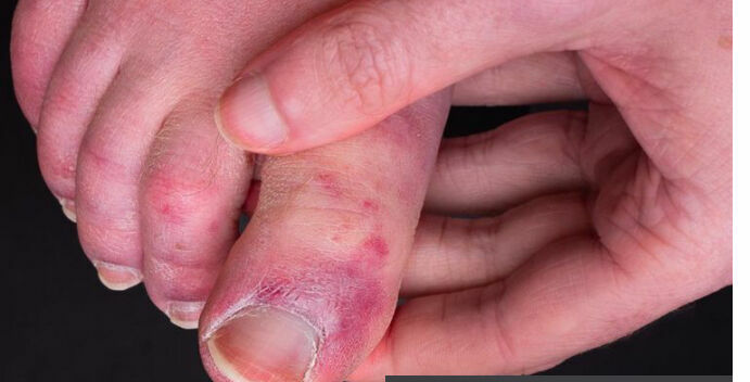 Британские врачи изучают последствия ковида, похожие на обморожения пальцев
