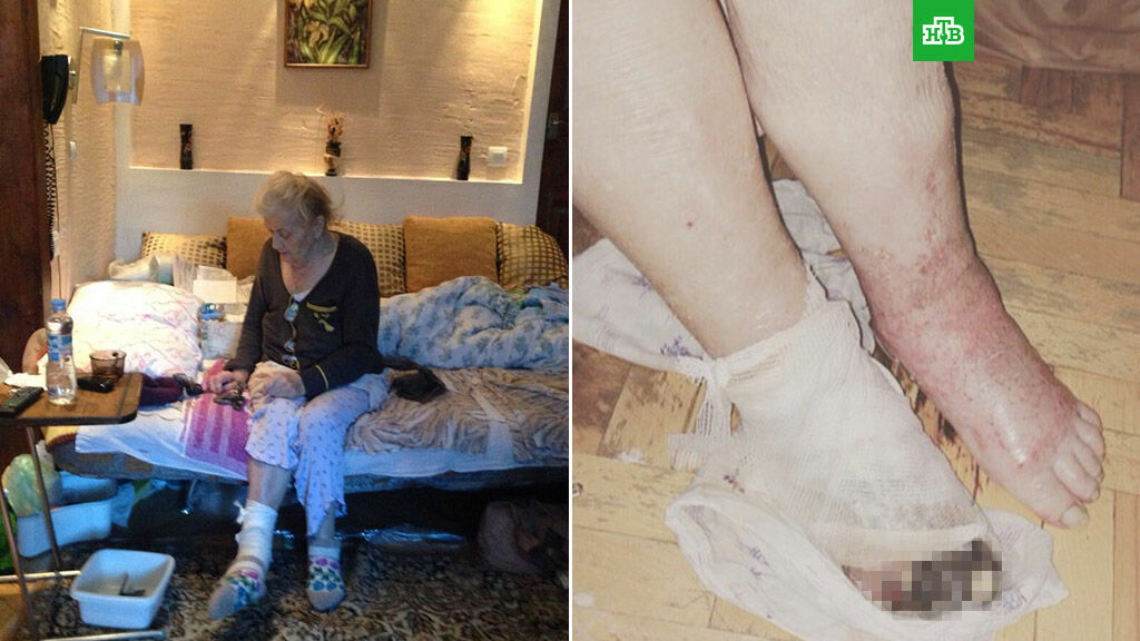 В Воронеже хирург ампутировал у 89-летней бабушки здоровую ногу