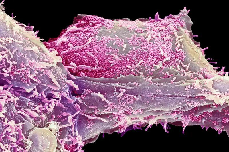 Человеческая клетка, пораженная вирусом герпеса