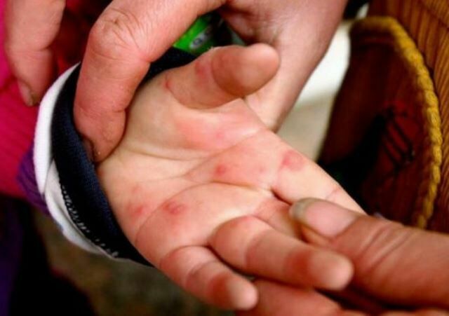 Более 50 детей из Сургута заразились вирусом Коксаки