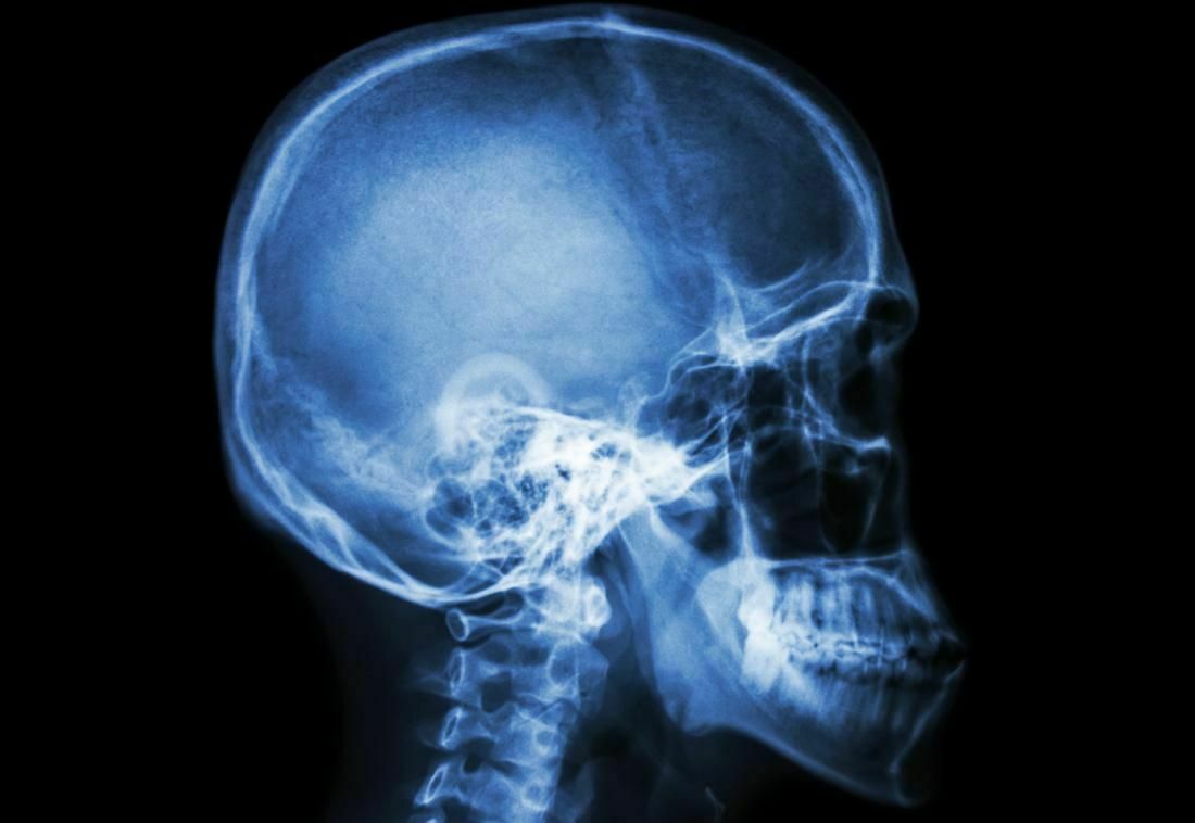 В Чехии ПЦР-тест привел к «утечке» спинномозговой жидкости через нос пациента