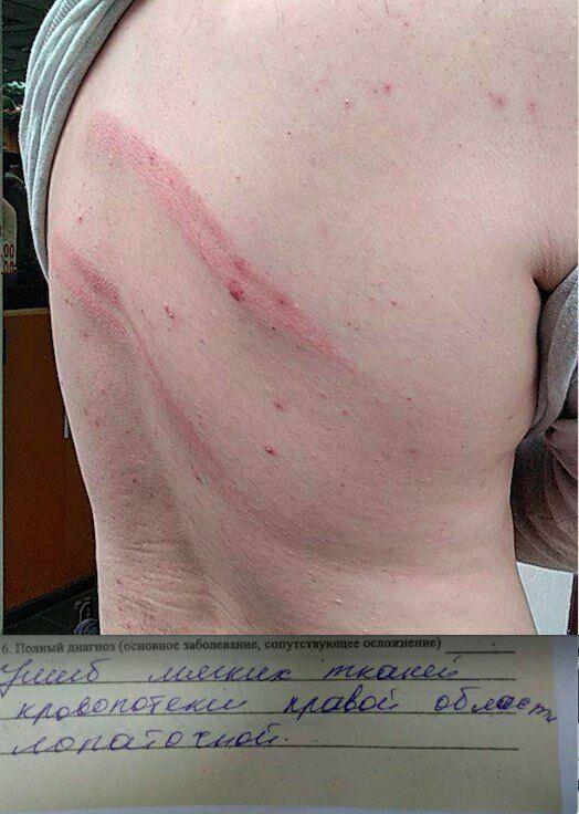 У одного из участников акции в Питере Егора Карпенко диагностировали ушиб мягких тканей, кровоподтеки. 