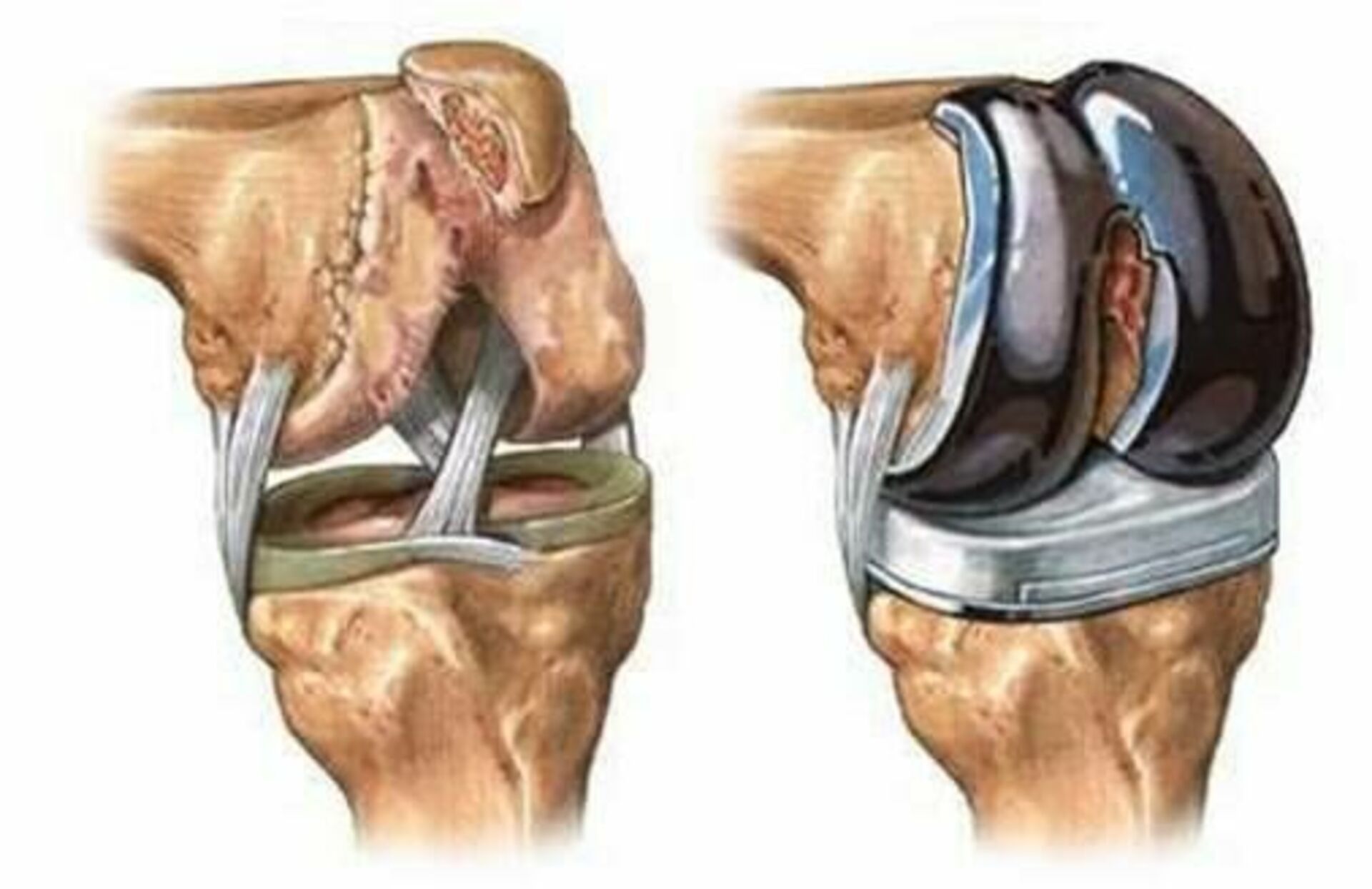 Отзывы после операции по замене. Гонартроз эндопротезирование коленного сустава. Эндопротез коленного сустава. Гонартроз коленного сустава операция. Гонартроз 3 степени коленного сустава эндопротезирование.