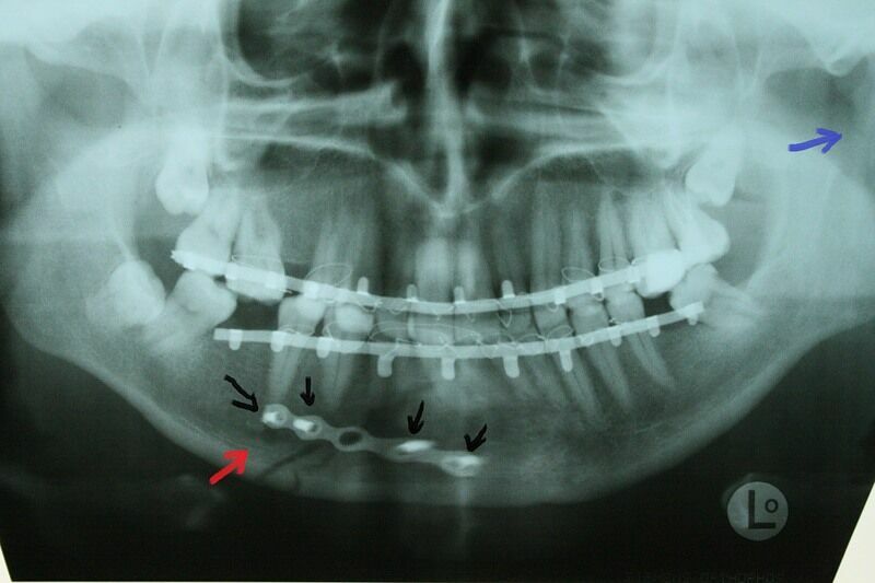В стоматологии Оренбурга пациентке сломали челюсть