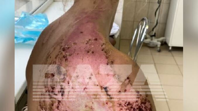В НИИ им. Склифосовского пациентка загорелась прямо во время операции