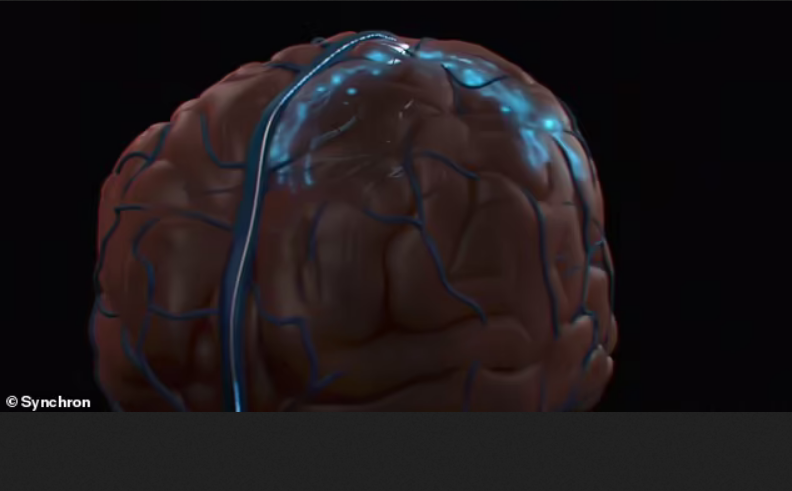 Маска опередили: компания Synchron имплантировала чип в мозг человека