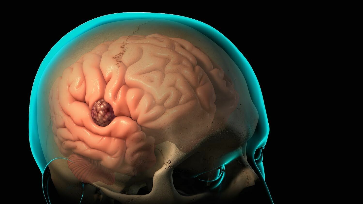 Дешево и просто: российские ученые научились со 100% точностью выявлять опухоль мозга