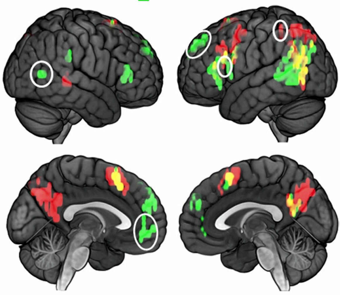 Группы активных нейронов у склонных к суициду (красные), контрольной группы (зеленые) и общие для тех и других (желтые). Белым показаны основные различающиеся участки