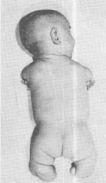 Прием препарата Талидомид  у беременных часто приводит к патологии конечностей у детей.  Это знают врачи многих стран. Почему  в таком случае  этот препарат с легкостью прошел регистрацию в России? 