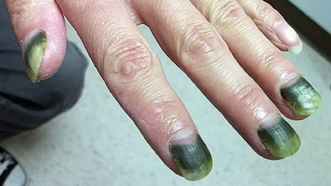 Синдром зеленого ногтя