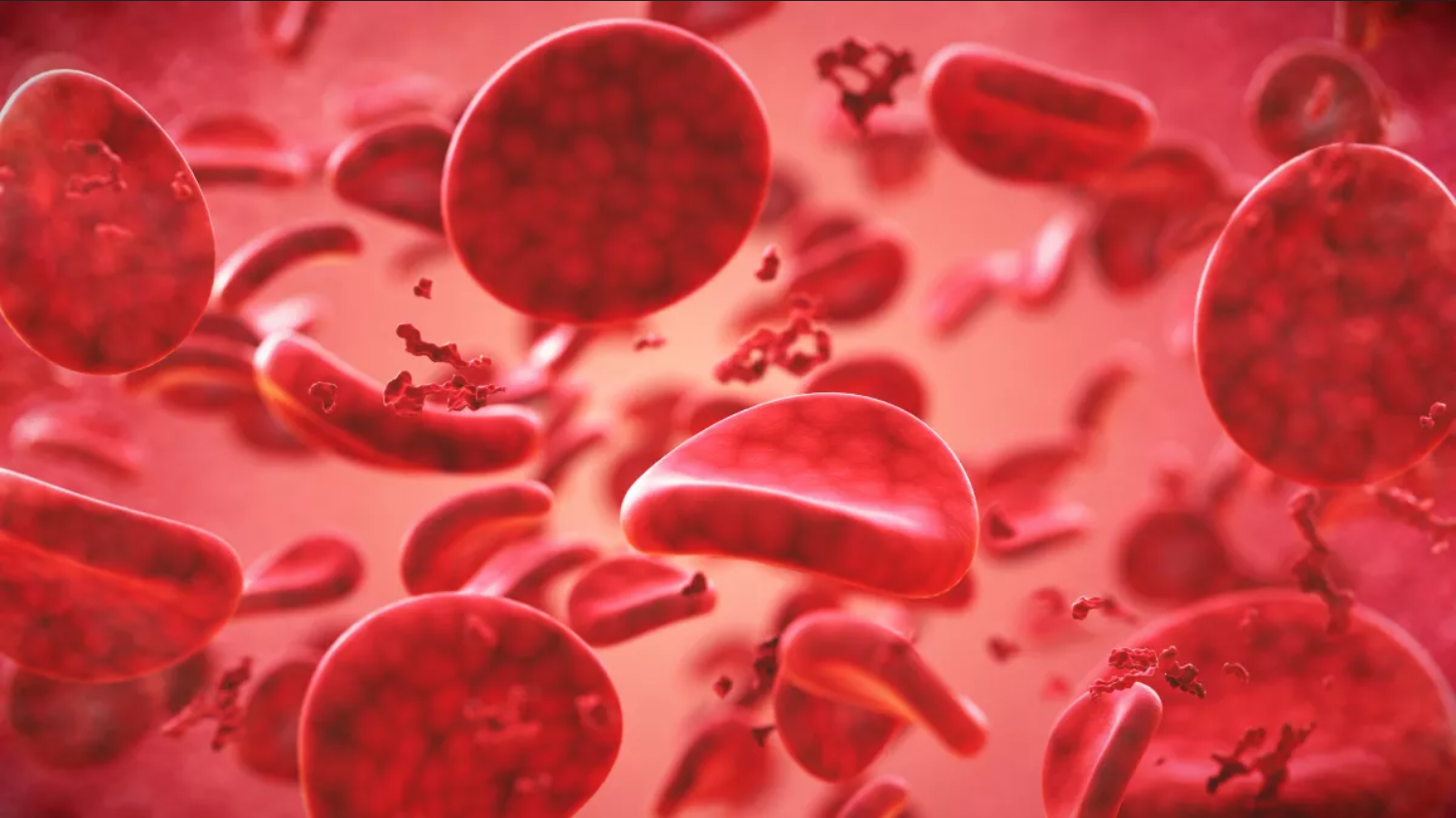 Обнаружена связь между группой крови и ранним инсультом