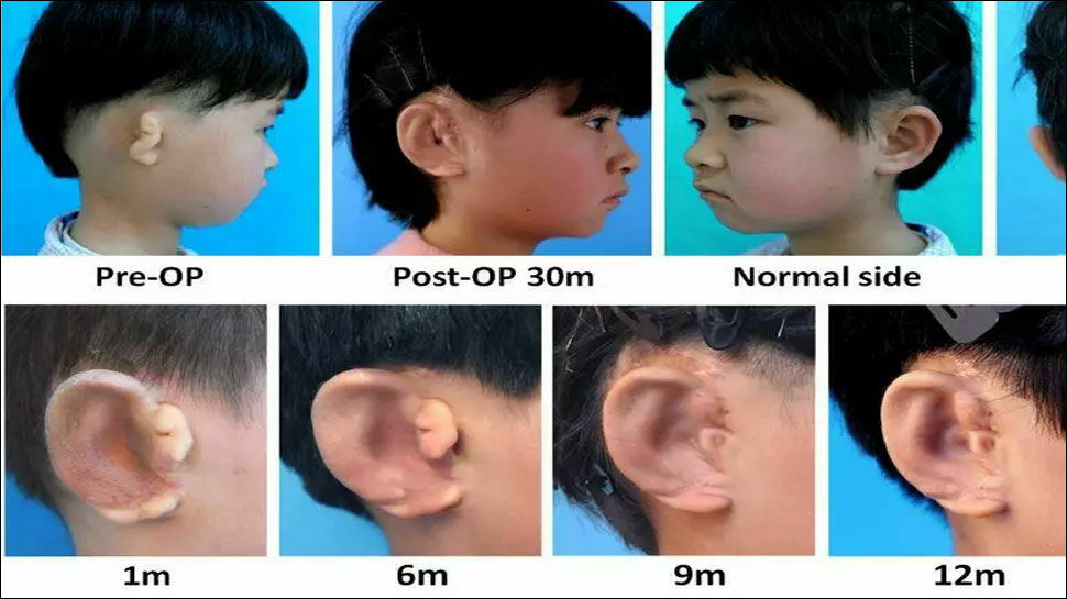 В Китае пересадили пациентам напечатанные на 3-D принтере уши
