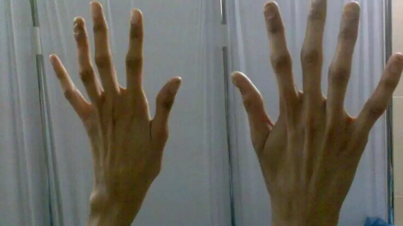 В некоторых случаях арахнодактилии все или несколько пальцев на руке обладают большой гибкостью и способностью быть отклонёнными назад на 180 градусов