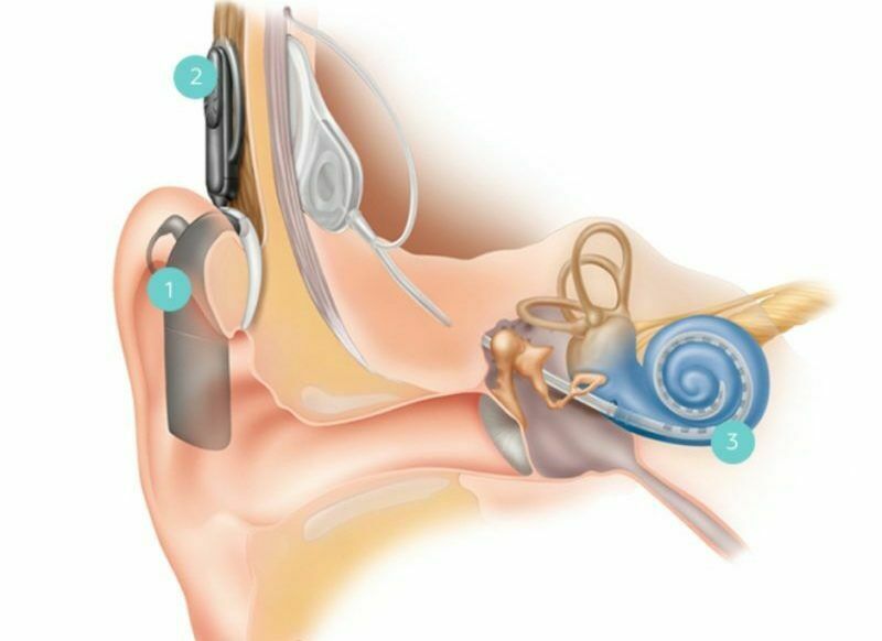 Вид  импланта слухового аппарата изнутри